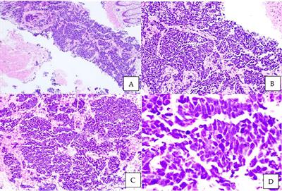 A rare case of prostate neuroendocrine tumor: A case report